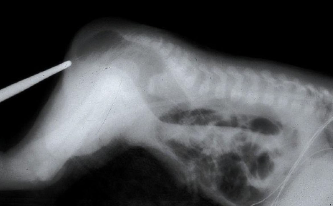 Anorectal malforamtion, Robotic Surgery in India, Robotic Surgery Hospitals in India